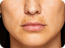 What is Uneven Skin Tone_ 10 Ways to Fix It