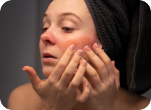 woman-looking-her-rosacea-mirror